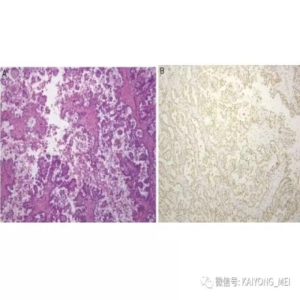卵巢癌的病理诊断新进展（三）