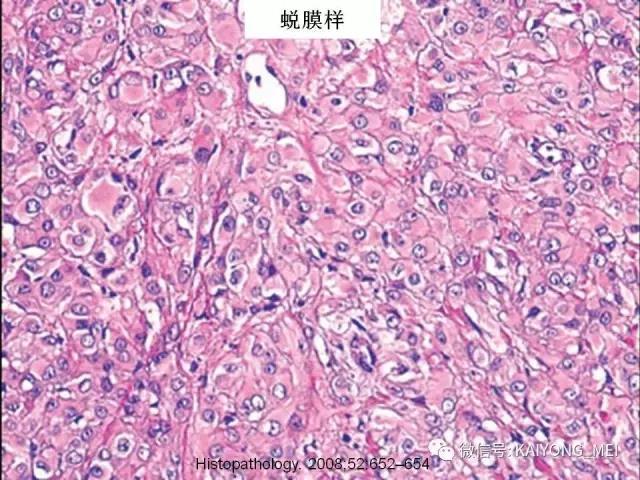 乳腺梭形细胞病变的病理诊断及进展（一）