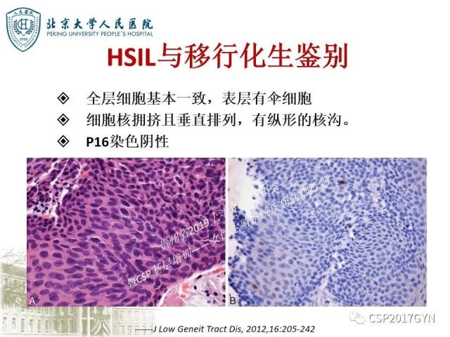 中华病理学会基层培训遵义站讲座（三）——宫颈鳞状上皮病变的病理诊断与鉴别诊断