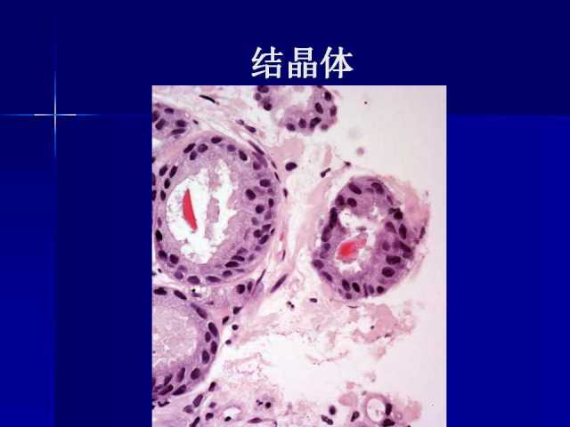前列腺病理诊断线索（上）——黄教悌