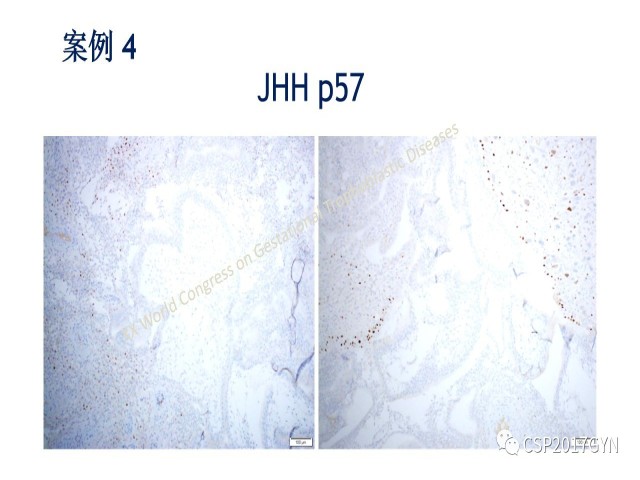 p57免疫组化染色及基因分型 在葡萄胎精确诊断中的应用