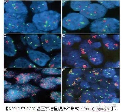 EGFR FISH的预测能力与突变相当——中山大学肿瘤医院数据引起的思考