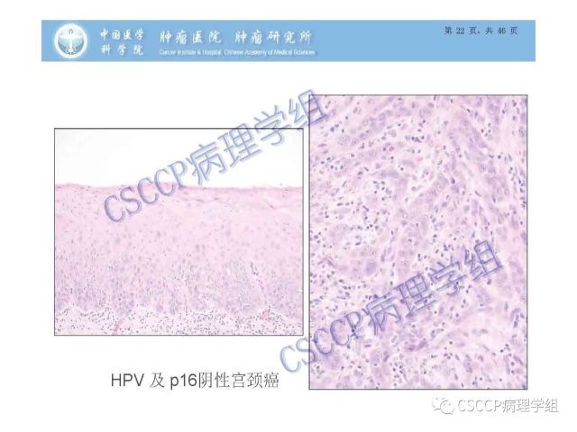 宫颈癌前病变中的诊断难点及阴道镜中ECC的 应用价值