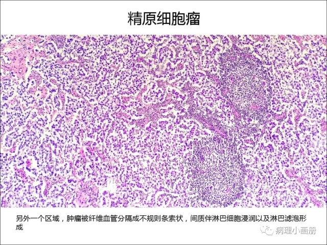 泌尿病理--精原细胞瘤VS精母细胞瘤