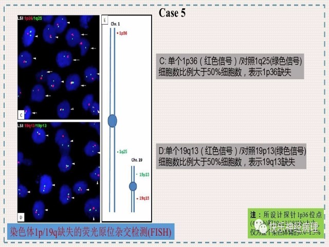 胶质瘤分子结果矛盾时如何整合诊断