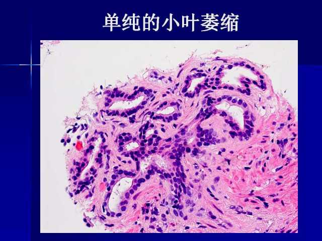前列腺病理诊断线索（下）——黄教悌