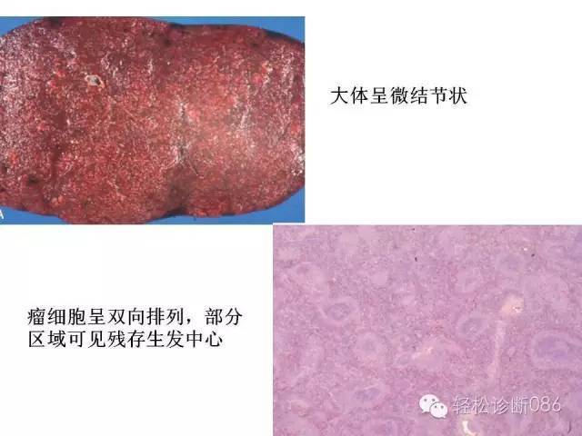 边缘区淋巴瘤（附小B细胞NHL鉴别诊断）