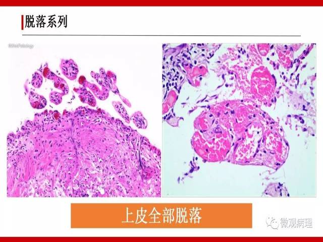 泌尿课程/非浸润性尿路上皮病变诊断的一些困惑