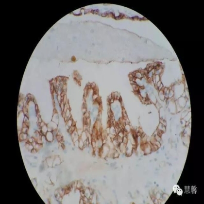 透明细胞乳头状肾细胞癌？TFE3 Traslocation Carcinoma？（赵洋分享，孔祥田(Max)*NM老师讲解）