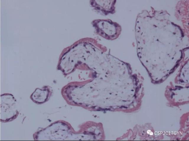 妊娠滋养细胞肿瘤的临床病理学进展