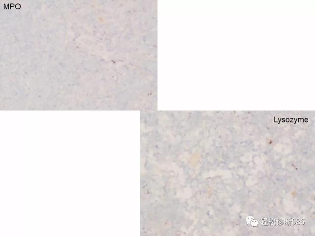 BPDCN病例分享