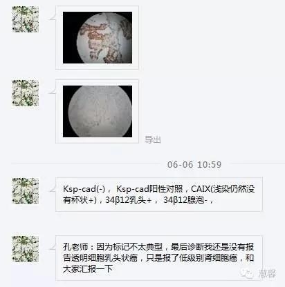 透明细胞乳头状肾细胞癌？TFE3 Traslocation Carcinoma？（赵洋分享，孔祥田(Max)*NM老师讲解）