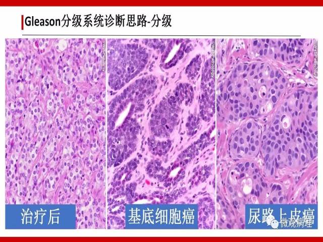 前列腺癌Gleason分级系统的前世今生