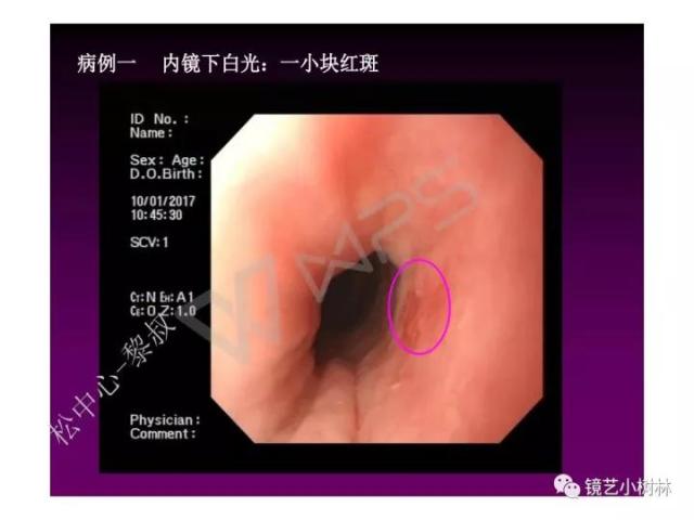 上消化道早癌病理的学习心得体会（附胃牵手癌的病例特点文献学习）