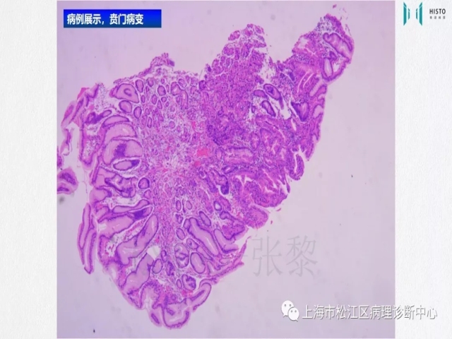 上消化道早癌病理诊断中的困惑及基本对策回顾