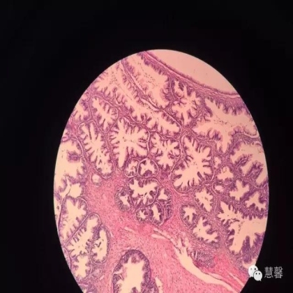 交界性黏液性囊腺瘤？癌？（魏娉分享，刘从容老师讲解）