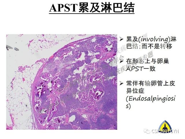 中华病理学会基层培训遵义站讲座（一）——卵巢和输卵管浆液性肿瘤的诊断和鉴别诊断