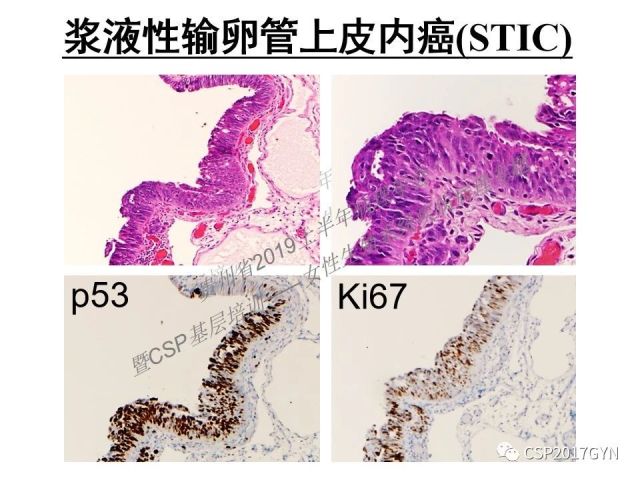 中华病理学会基层培训遵义站讲座（一）——卵巢和输卵管浆液性肿瘤的诊断和鉴别诊断