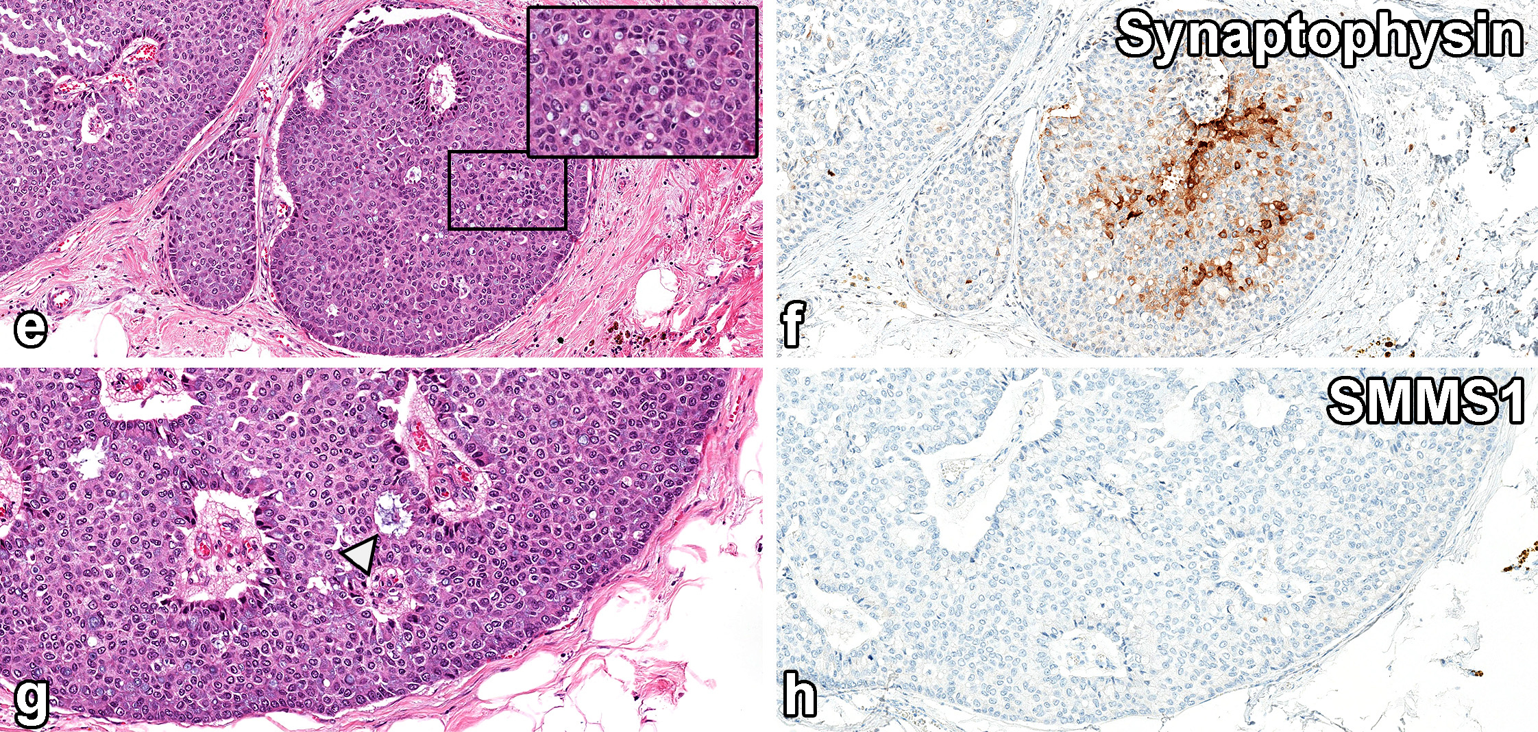 读文献，学病理-乳腺乳头状肿瘤难点总结（一）