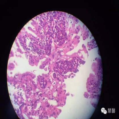 子宫内膜乳头状增生（甜甜分享病例，孔祥田(Max)*Roswell*老师讲解，kent翻译整理文献）