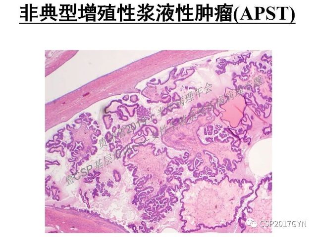 中华病理学会基层培训遵义站讲座（一）——卵巢和输卵管浆液性肿瘤的诊断和鉴别诊断