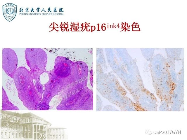 中华病理学会基层培训遵义站讲座（三）——宫颈鳞状上皮病变的病理诊断与鉴别诊断