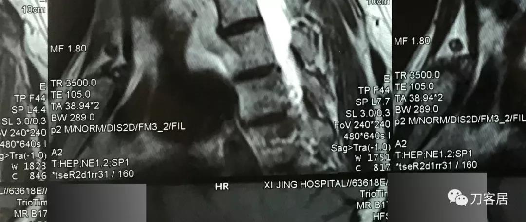 医生及患者通用:如何用手机翻拍X线片,磁共振片子,CT片子进行网络求医、病例讨论及保留资料 医生及患者通用:如何用手机翻拍X线片,磁共振片子,CT片子进行网络求医、病例讨论及保留资料