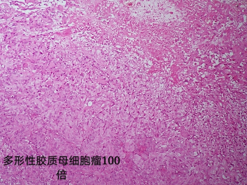 病理科工作札记（三十八）胶质母细胞瘤