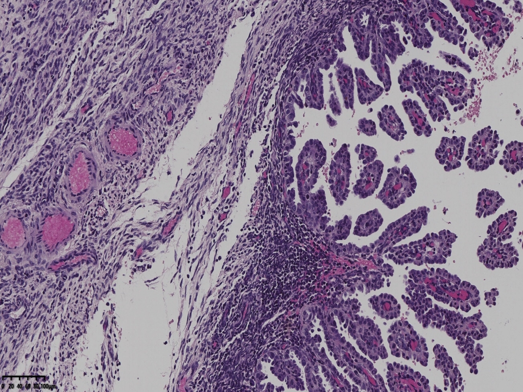 子宫透明细胞癌？