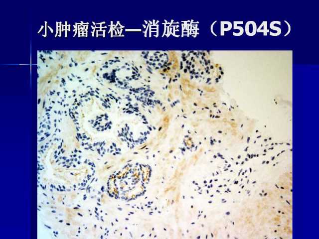 前列腺病理诊断线索（下）——黄教悌