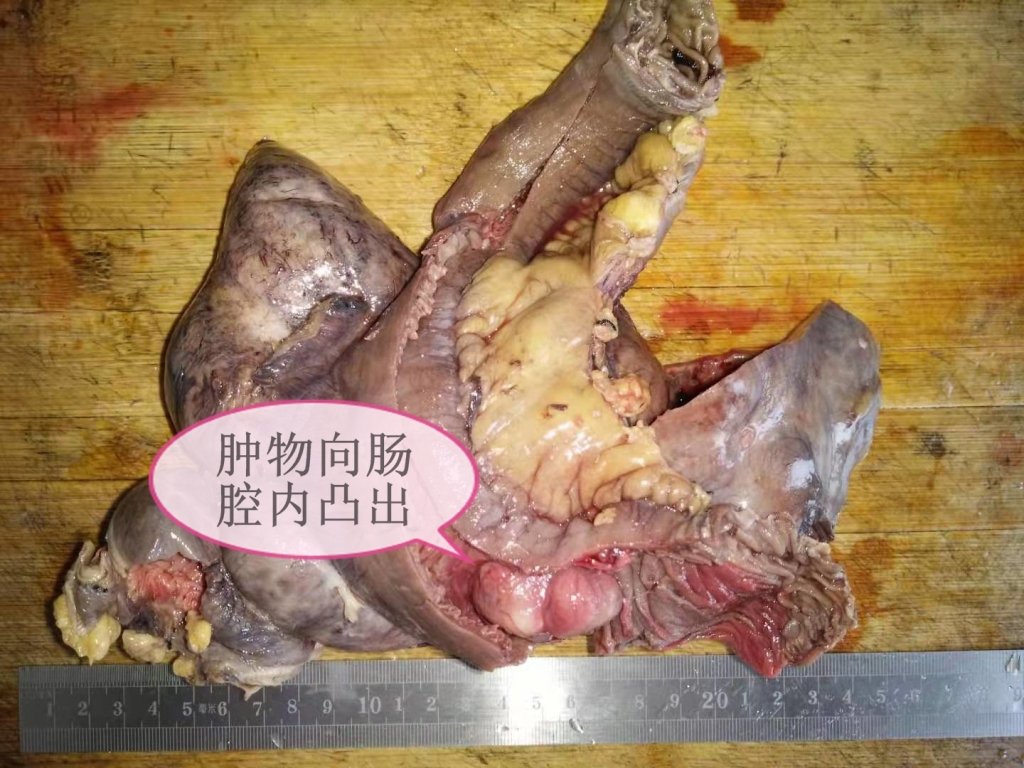 外伤引发间质瘤出血——病理科工作札记（五十五）