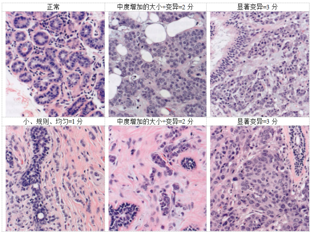 乳腺肿瘤WHO分类学习笔记（连载9）