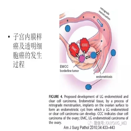 卵巢癌的病理诊断新进展（三）