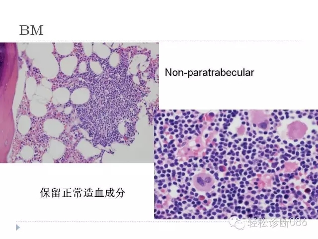 慢性淋巴细胞性白血病