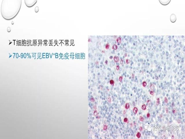血管免疫母T细胞淋巴瘤的病理诊断
