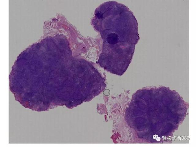 HIV/AIDS相关性LPDHIV感染相关淋巴瘤病例分析