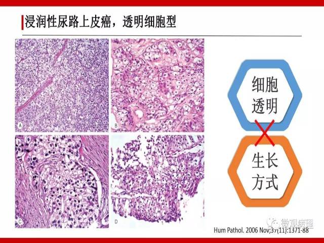 泌尿课程/浸润性尿路上皮癌病理学类型