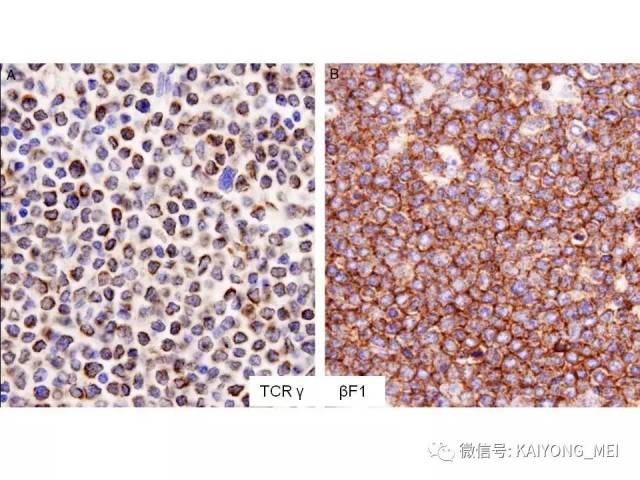 T细胞淋巴瘤病理诊断及进展（三）