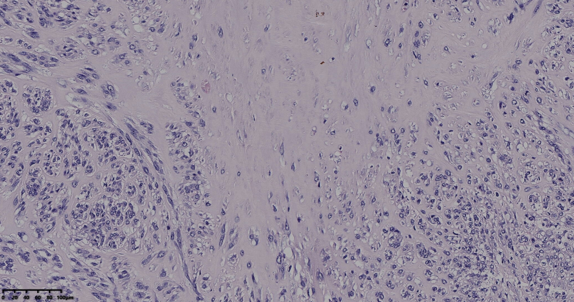 子宫多发性平滑肌瘤伴肉瘤