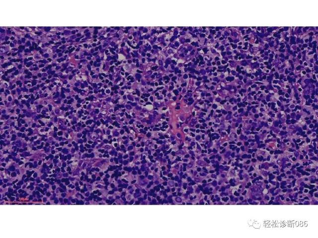 HIV/AIDS相关性LPDHIV感染相关淋巴瘤病例分析