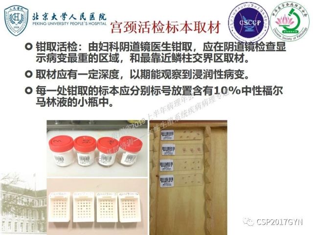 中华病理学会基层培训遵义站讲座（三）——宫颈鳞状上皮病变的病理诊断与鉴别诊断