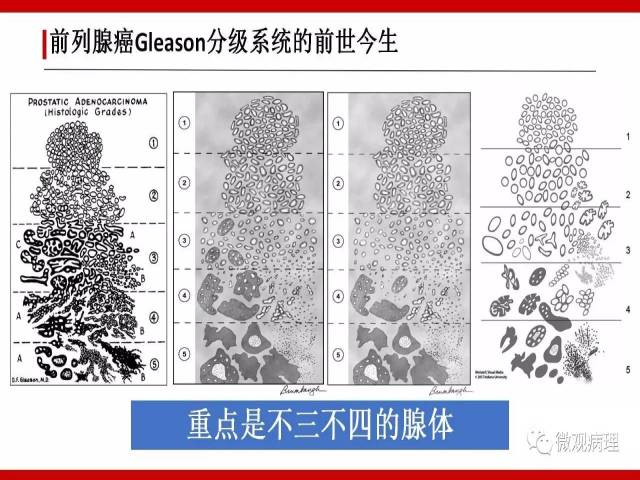 前列腺癌Gleason分级系统的前世今生