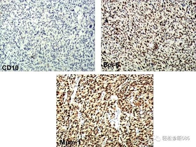 HIV/AIDS相关性LPDHIV感染相关淋巴瘤病例分析