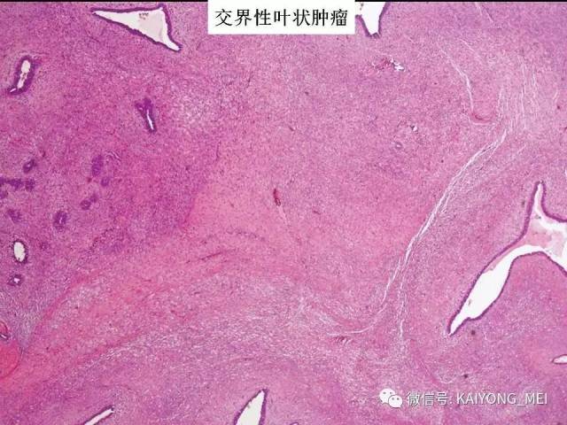 乳腺梭形细胞病变的病理诊断及进展（二）