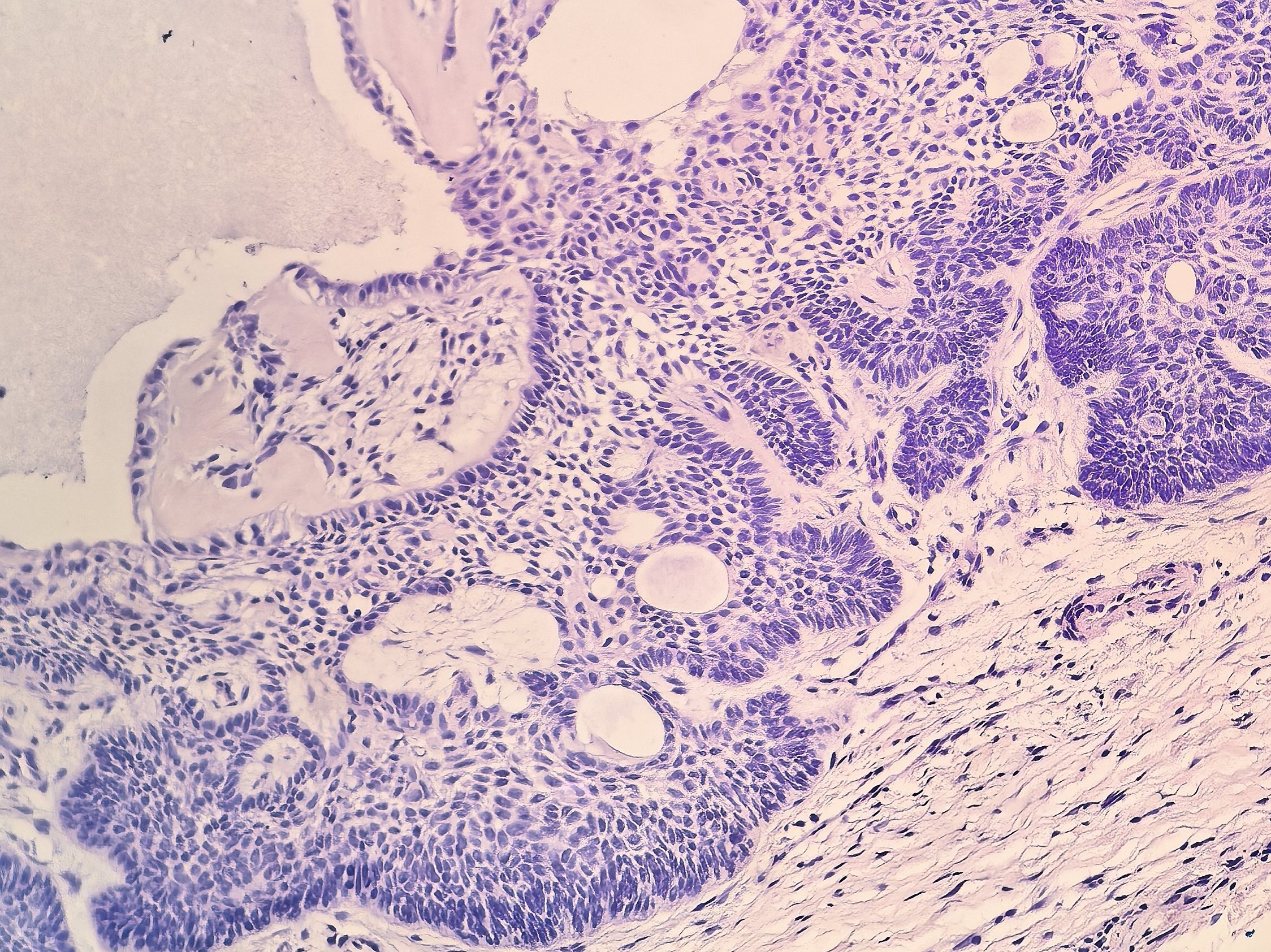 皮肤基底细胞癌伴骨样基质形成一例