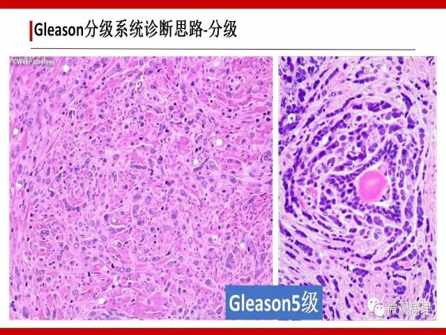 前列腺癌Gleason分级系统的前世今生