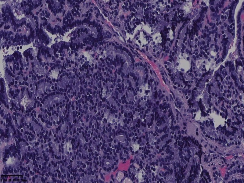 这个甲状腺肿瘤怎么看？