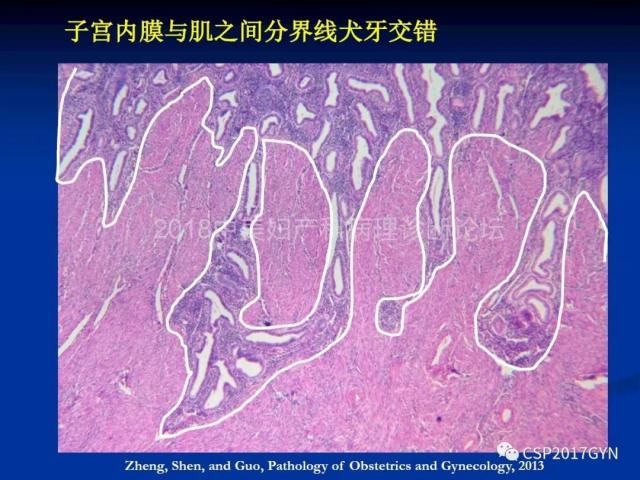 子宫内膜癌：诊断与进展