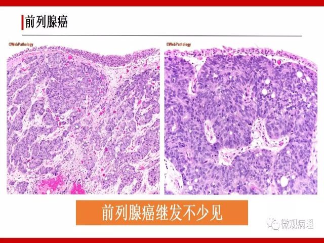 泌尿课程/尿路腺样病变的诊断要点