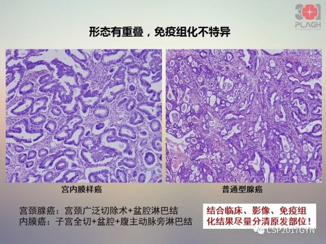 宫颈腺癌的临床病理研究进展